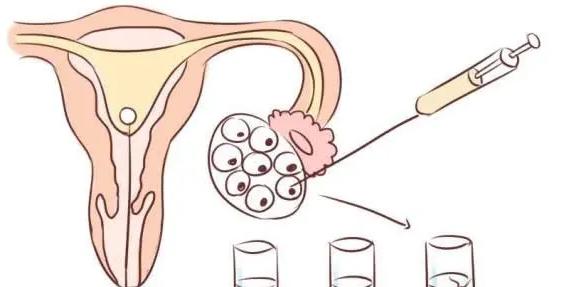  试管促排选择微刺激方案什么时候可以取卵