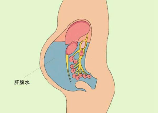 取卵后感觉肚子胀胀的是因为腹水了吗？