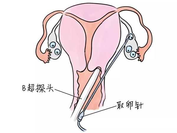 35岁试管取卵多的成功率大嘛？