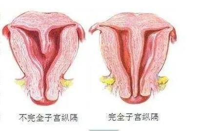 宫腔镜对切除纵膈子宫有什么作用？