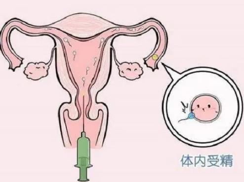 在上海九院做一次人工授精要多少钱？