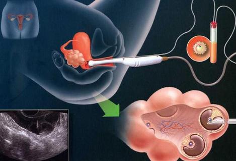 轻度子宫腺肌症去深圳做试管婴儿具体流程是怎么样的？