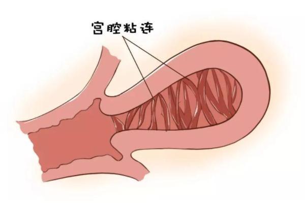 35岁严重宫腔粘连做试管婴儿前需要做的检查有哪些？