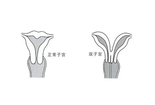 双角子宫患者进行试管婴儿可以移植冻胚吗？