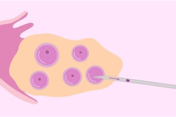 试管取卵后为何会出现排尿困难？
