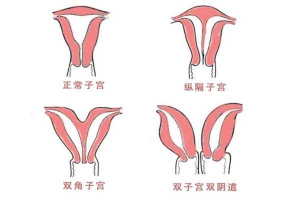 完全纵隔子宫做试管婴儿的费用主要包括哪些方面？