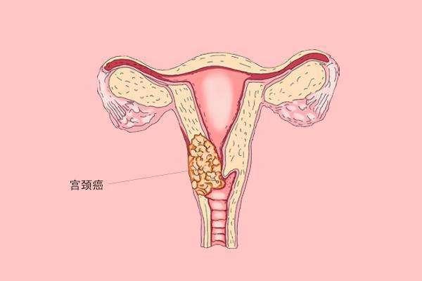 患有宫颈癌去俄罗斯做试管婴儿的过程是怎样的？如何治疗宫颈癌？