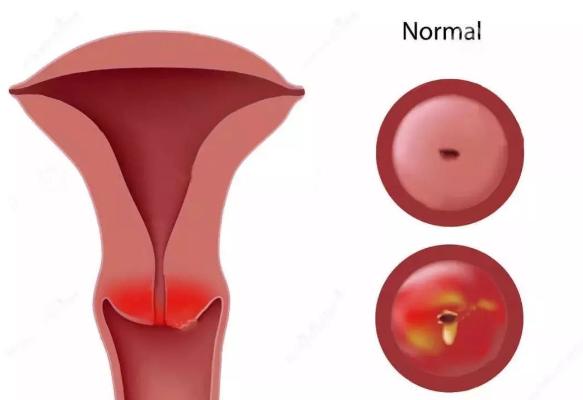 宫颈炎的常见治疗方法有哪些？以后应该怎么日常护理和预防？