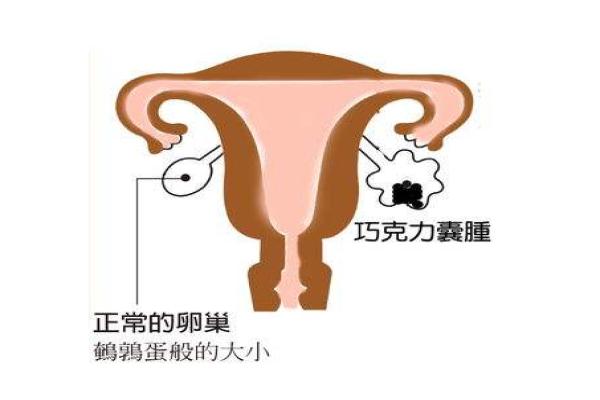 患有左侧卵巢囊肿在济南做供卵试管婴儿的费用是多少？