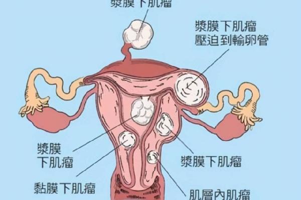 子宫肌瘤5cm做试管婴儿能成功吗？子宫肌瘤的治疗方法有哪些？