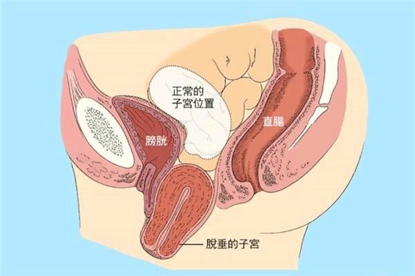 产后子宫会下垂吗？原因是什么？