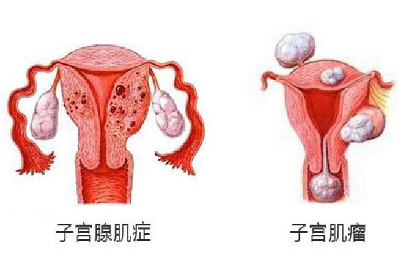 子宫腺肌瘤患者做试管婴儿应该选择长方案还是微刺激方案？