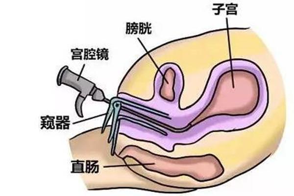 患有宫腔粘连在昆明做试管婴儿包成功要多少钱？