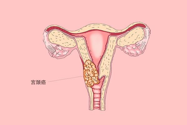 宫颈炎对试管婴儿影响大吗？如何选择合适的治疗方案?