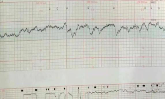 胎心基线低于100次会面临什么危险？