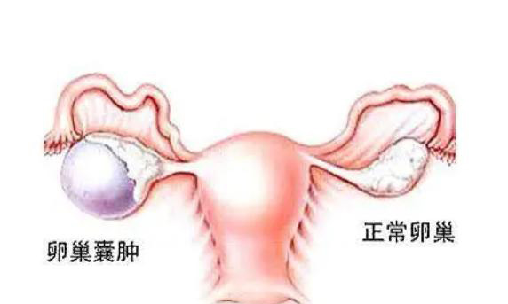 试管婴儿微刺激方案成功率高吗？卵巢囊肿2cm能不能做？