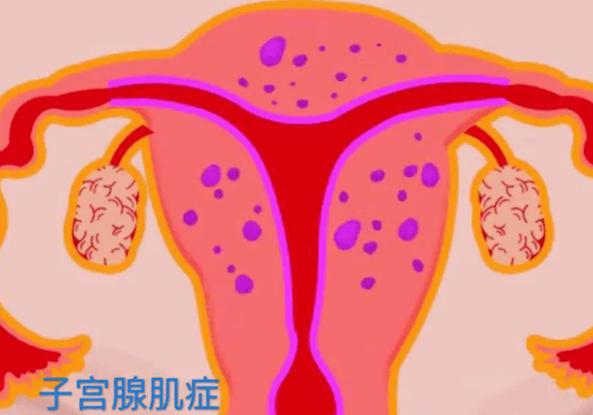 子宫腺肌症是什么原因造成的？