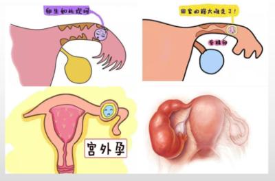 做试管胚胎移植到自己体内还会发生宫外孕吗？