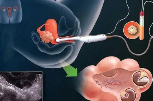 试管取卵要注意，注意事项望周知