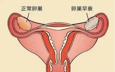 AMH1.0是卵巢早衰吗？不同年龄amh正常范围介绍 