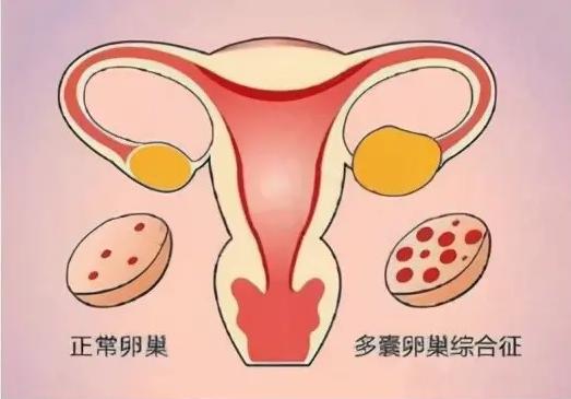 多囊激素不正常别急着促排，可能事倍功半