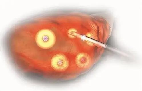 5个步骤详解试管婴儿取卵全过程