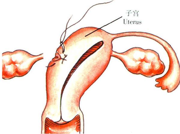 残角子宫也能怀孕,可以通过三代试管成功助孕