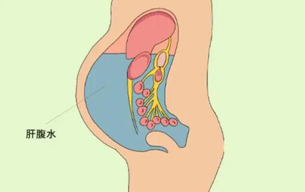 腹水开始吸收的表现，更快地让腹水消失