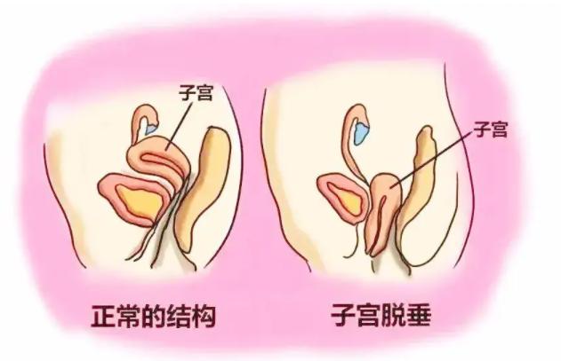 子宫脱垂有什么办法恢复正常,掌握好技巧并不难