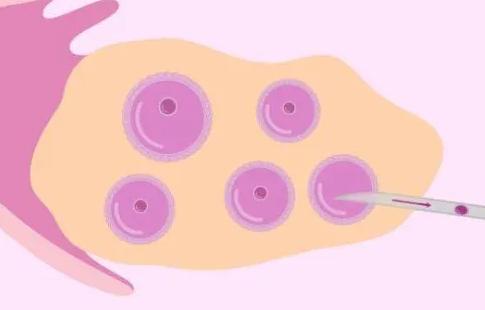 取出空卵泡的原因是因为取卵时间太早了吗？