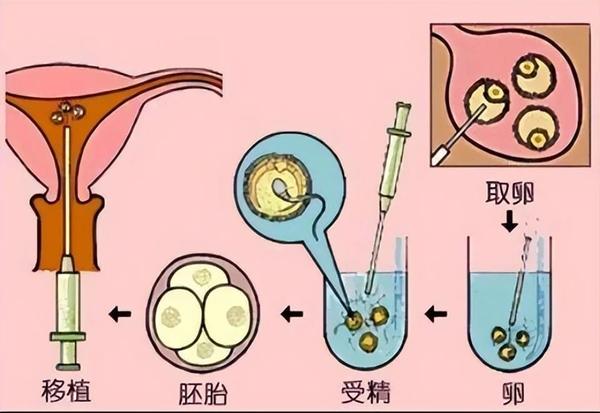 试管婴儿详细全过程解读，让你了解试管婴儿整个过程