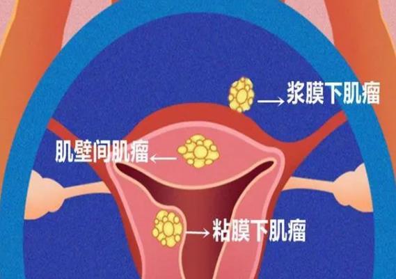 如何能让子宫肌瘤不影响试管几率，可以先做好这些方面的治疗