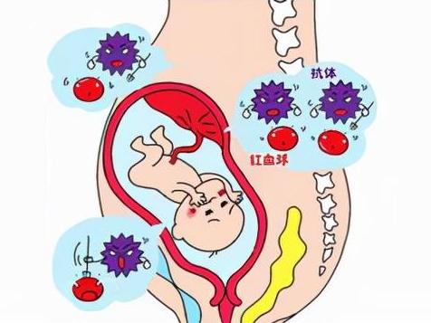 新生儿溶血症严重危害宝宝健康，治疗费用昂贵但及时治疗仍有望恢复