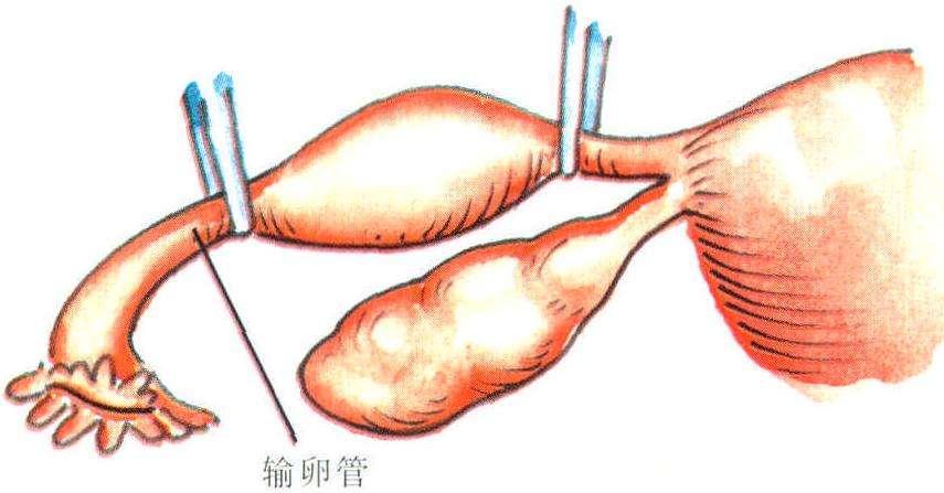 双侧输卵管炎会影响女性生育，但可通过试管成功孕育