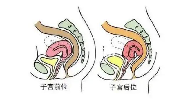 子宫前位和后位哪个更容易怀孕？