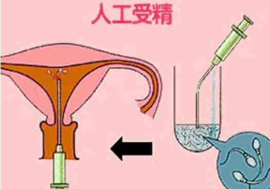 怀孕的成本到底有多高？孩子做人工受孕费用分析