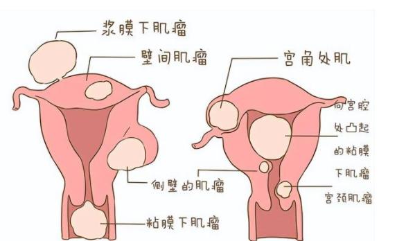 子宫腺肌瘤多大算严重？看看这个对照表就知道