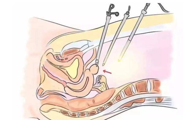 看这里！妇科腹腔镜四个孔位置让你一目了然