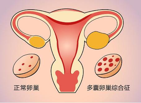 多囊患者做试管婴儿能提高生育成功率吗？具体情况不同成功率不同