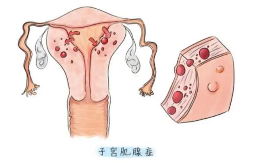 子宫腺肌症患者必看！是保留还是切除子宫？利弊分析在这里