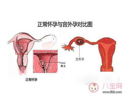 导致宫外孕危害相当大 生活中这样做可以预防