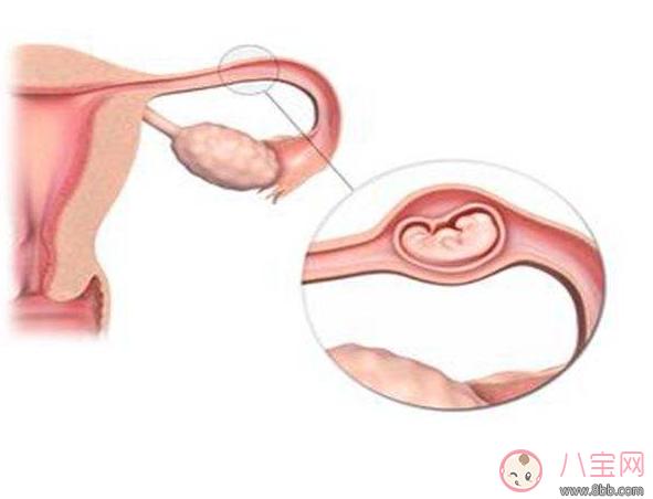 导致宫外孕危害相当大 生活中这样做可以预防