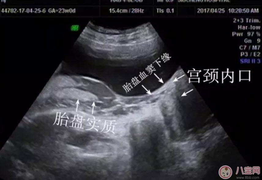 孕妇胎盘低怎么办 孕妇胎盘低是什么原因造成的(胎盘低要注意什么)