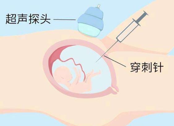 羊水穿刺风险大吗