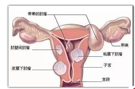 子宫切除的原因有哪些？子宫切除对身体有哪些影响？.png