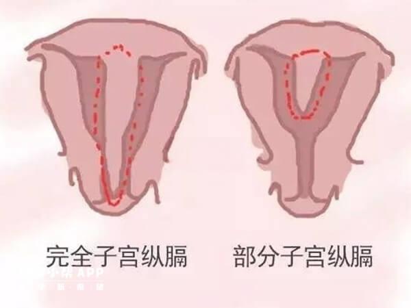 
              纵隔子宫采用内分泌药物治疗和子宫融合术哪个更有效？
            