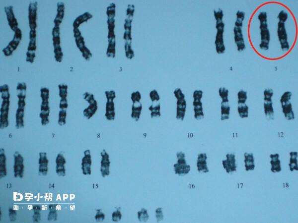 5号染色体缺失会负面影响孩子一生