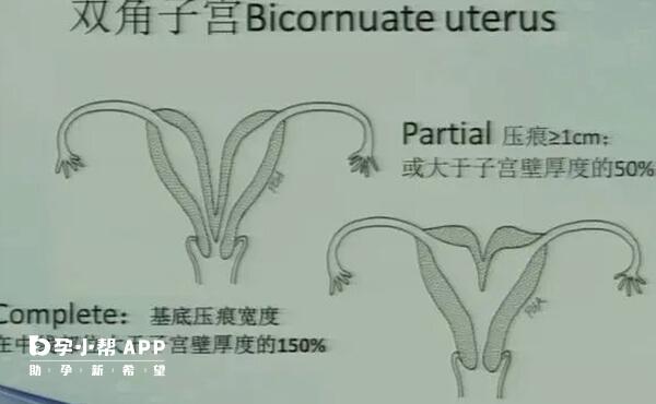 双角子宫通过B超检查就能诊断